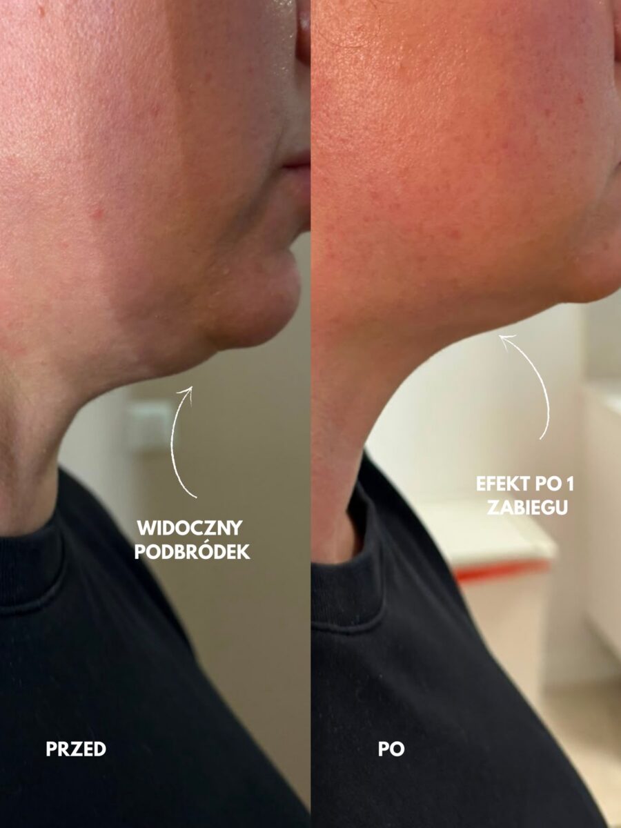 Efekt INDIBA — lifting i ujędrnienie, przed i po | Holiestetyka Kraków