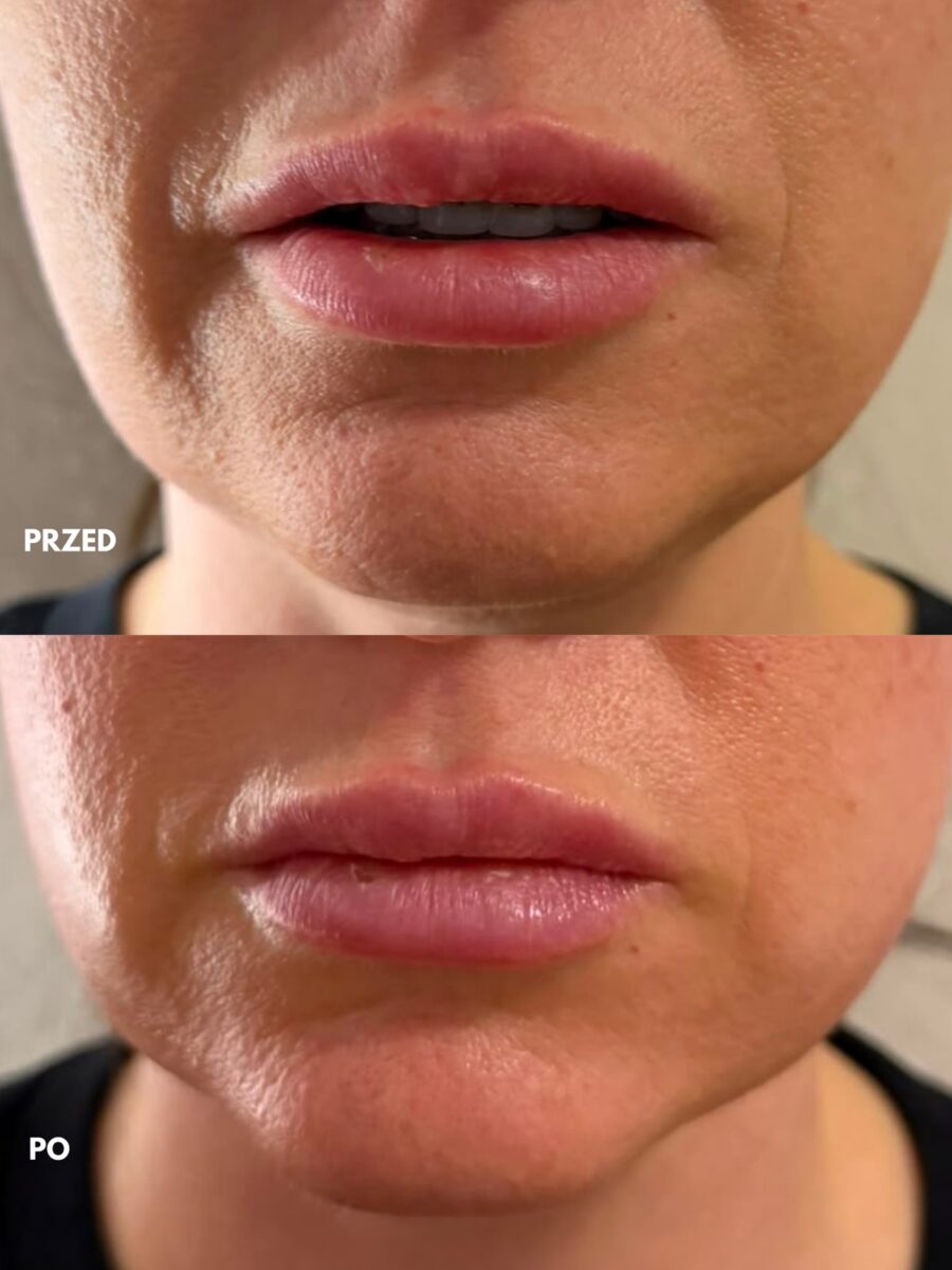 Efekt kosmetologii medycznej — odmłodzenie skóry, przed i po | Holiestetyka Kraków