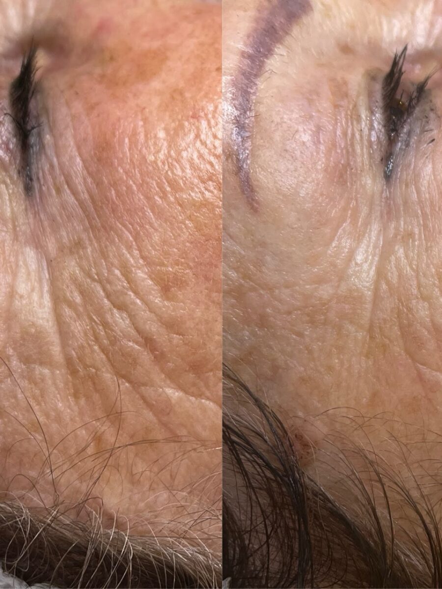 Efekt laseroterapii i terapii skóry — przed i po | Holiestetyka Kraków