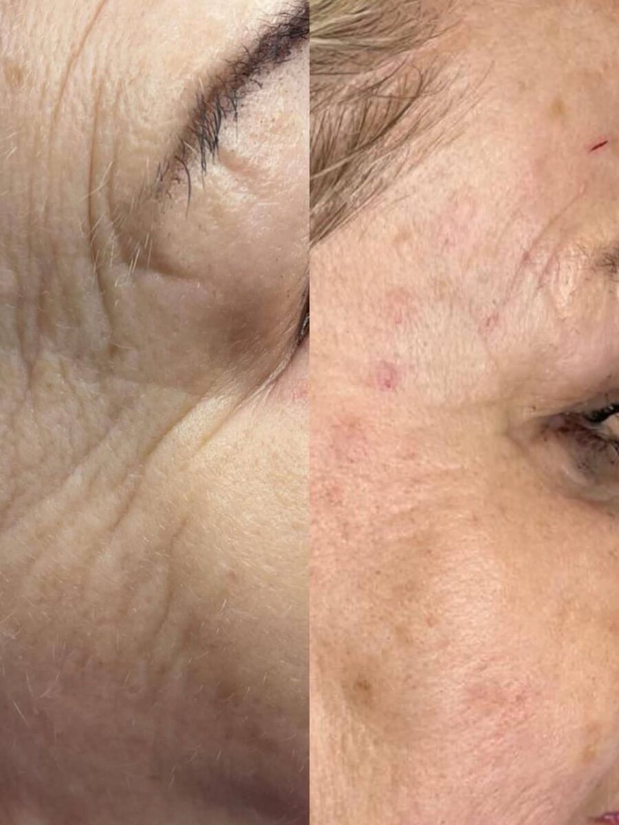 Efekt laseroterapii i terapii skóry — przed i po | Holiestetyka Kraków