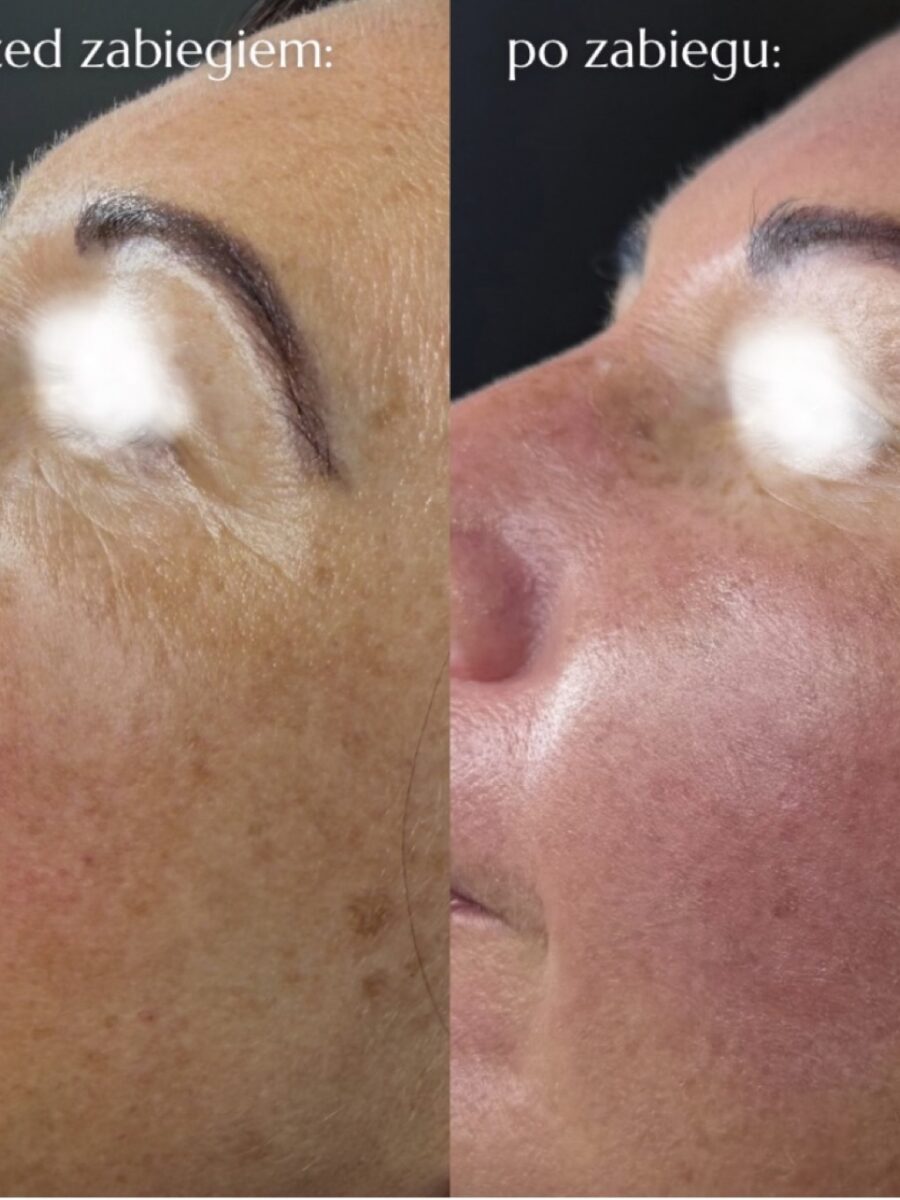 Efekt laseroterapii i terapii skóry — przed i po | Holiestetyka Kraków