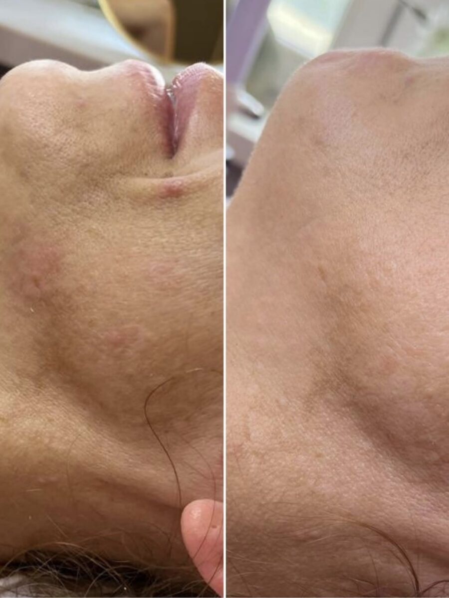 Efekt laseroterapii i terapii skóry — przed i po | Holiestetyka Kraków