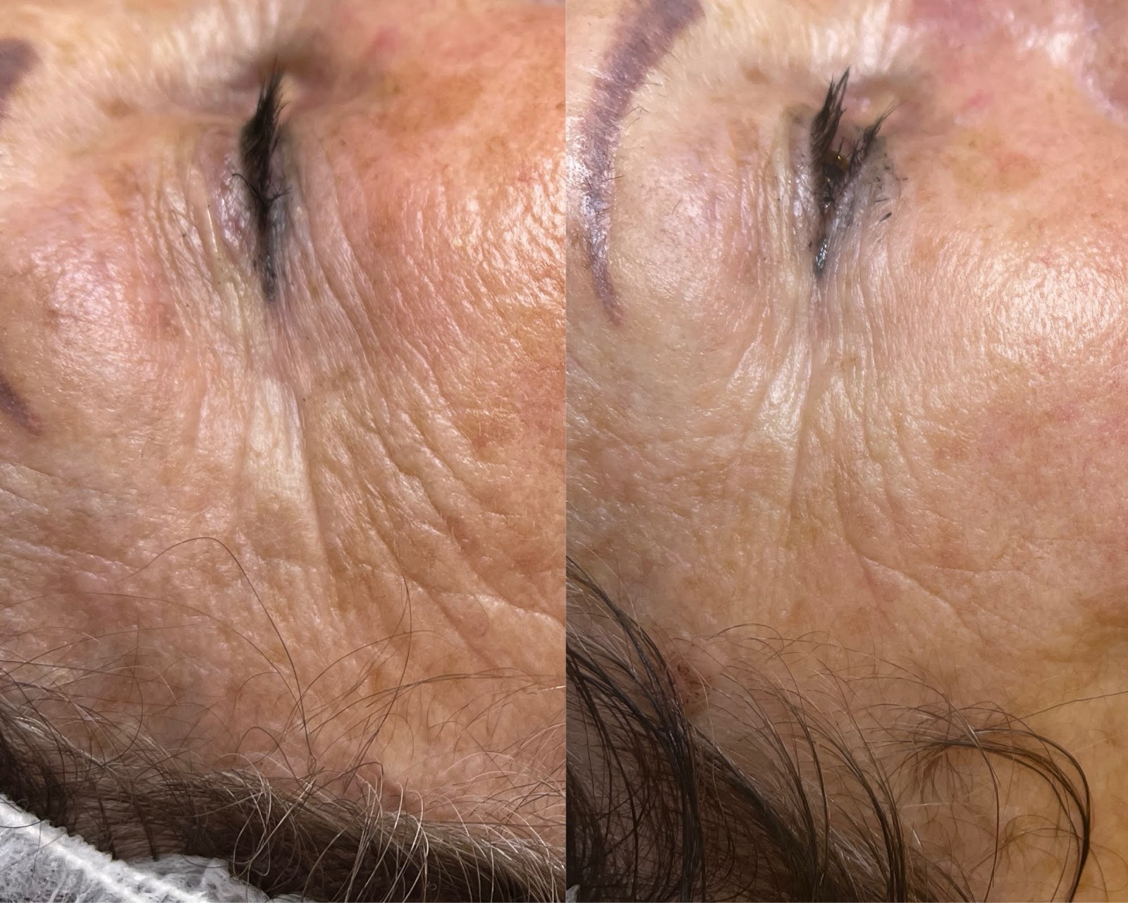 Efekt laseroterapii i terapii skóry — przed i po | Holiestetyka Kraków