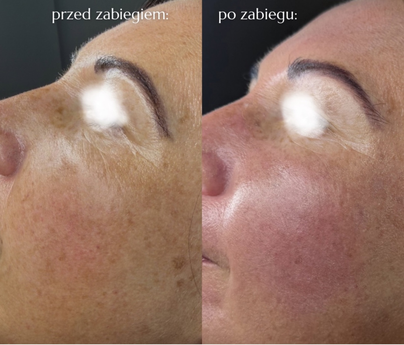Efekt laseroterapii i terapii skóry — przed i po | Holiestetyka Kraków