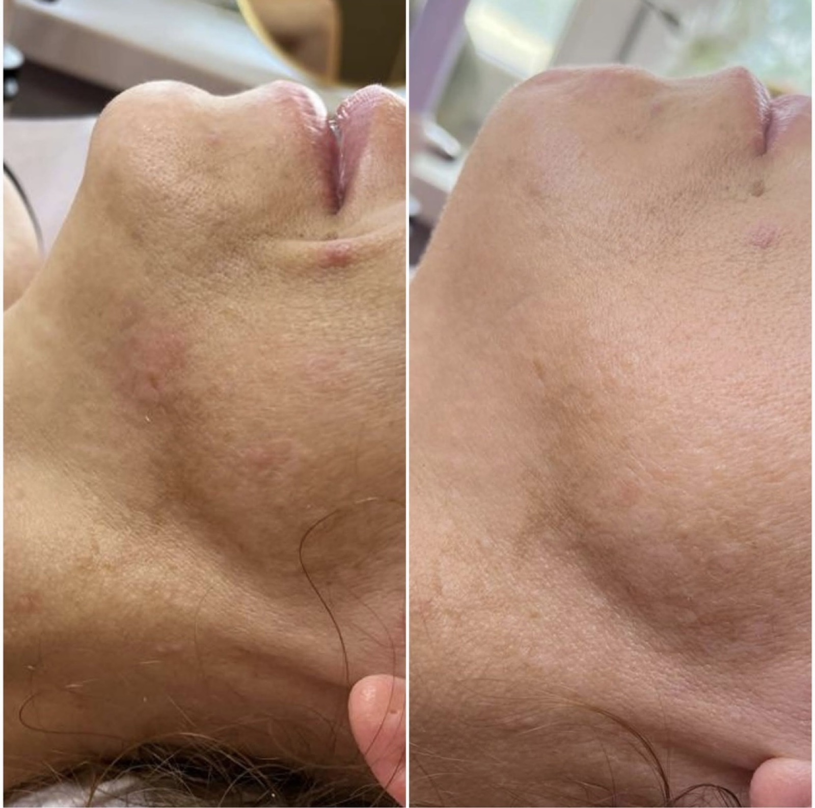 Efekt laseroterapii i terapii skóry — przed i po | Holiestetyka Kraków