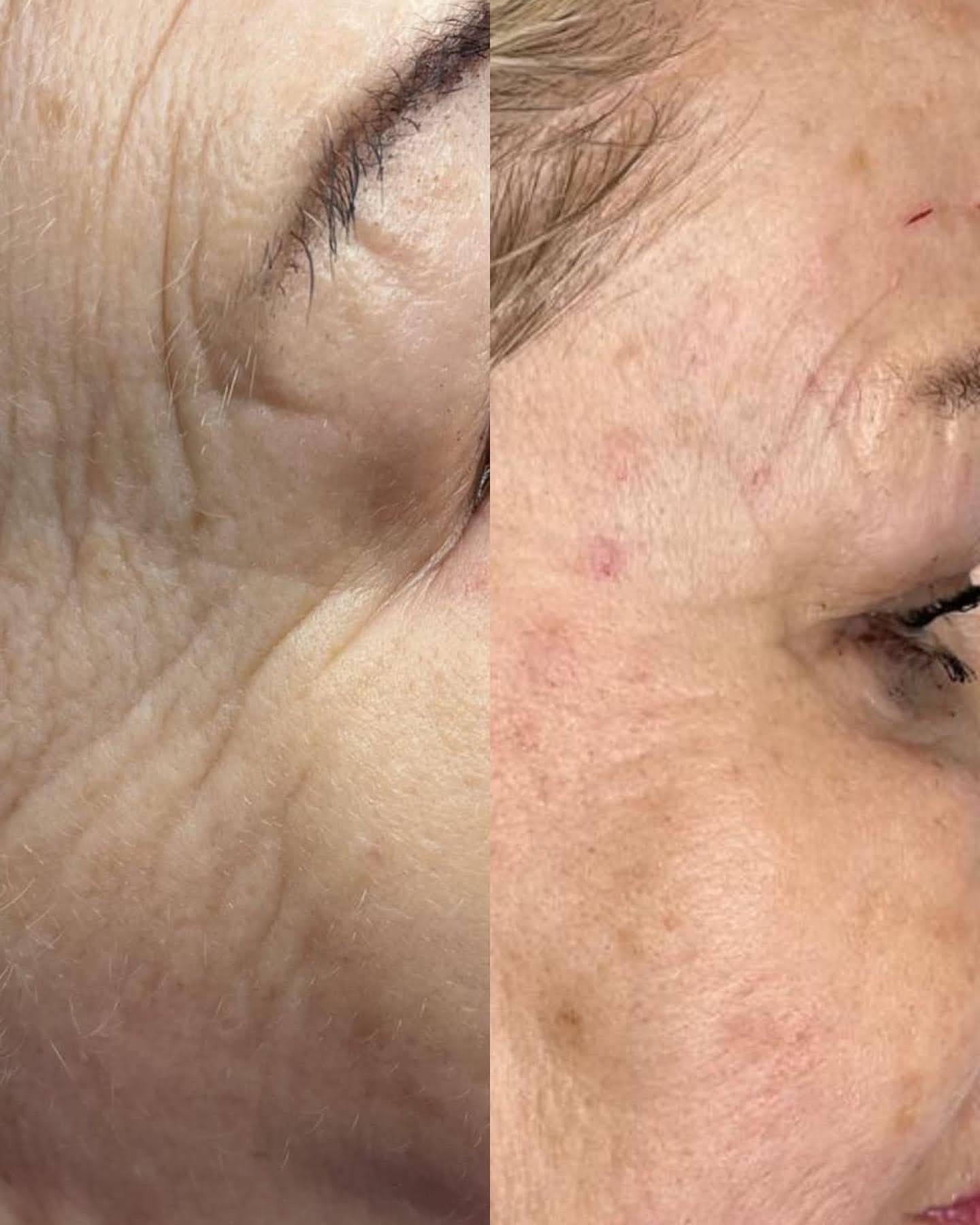 Efekt terapii okolic oka — przed i po | Holiestetyka