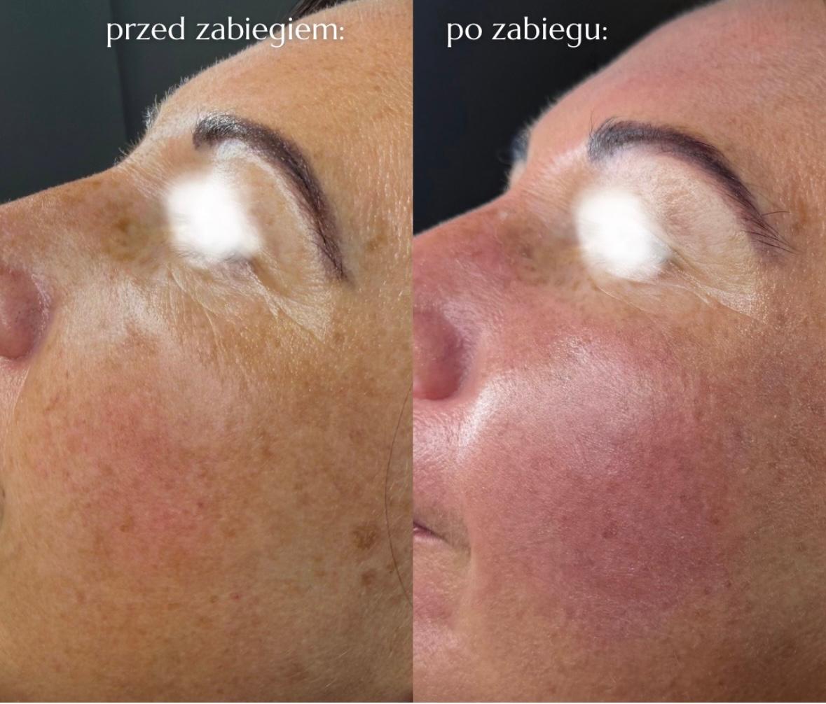 Efekt INDIBA® — twarz przed i po | Holiestetyka