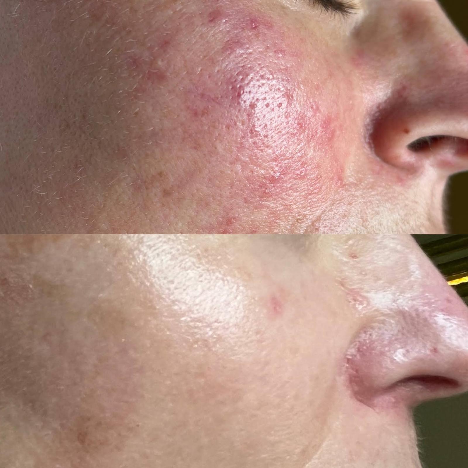 Laseroterapia i leczenie dermatoz — trądzik przed i po | Holiestetyka