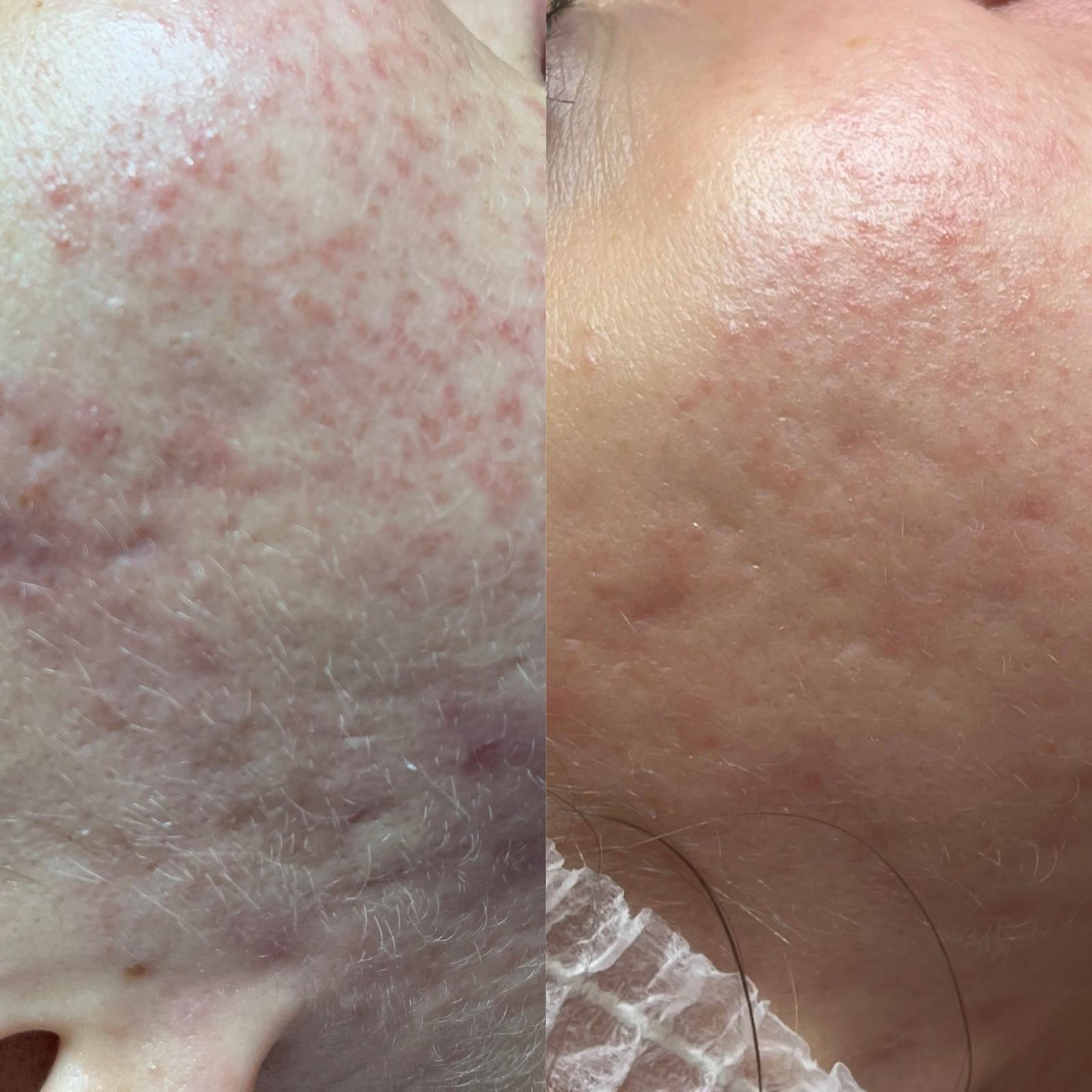 Laseroterapia — skóra przed i po | Holiestetyka