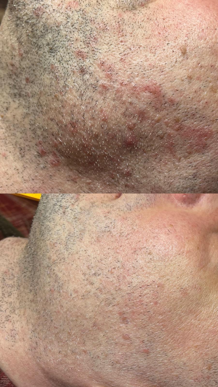 Laseroterapia — skóra z zarostem przed i po | Holiestetyka